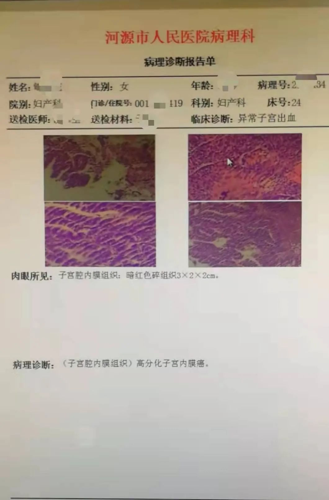 行分段诊刮术病理结果示提示高分化子宫内膜癌